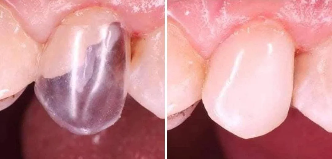 Dental Transparent Crown - Image 4