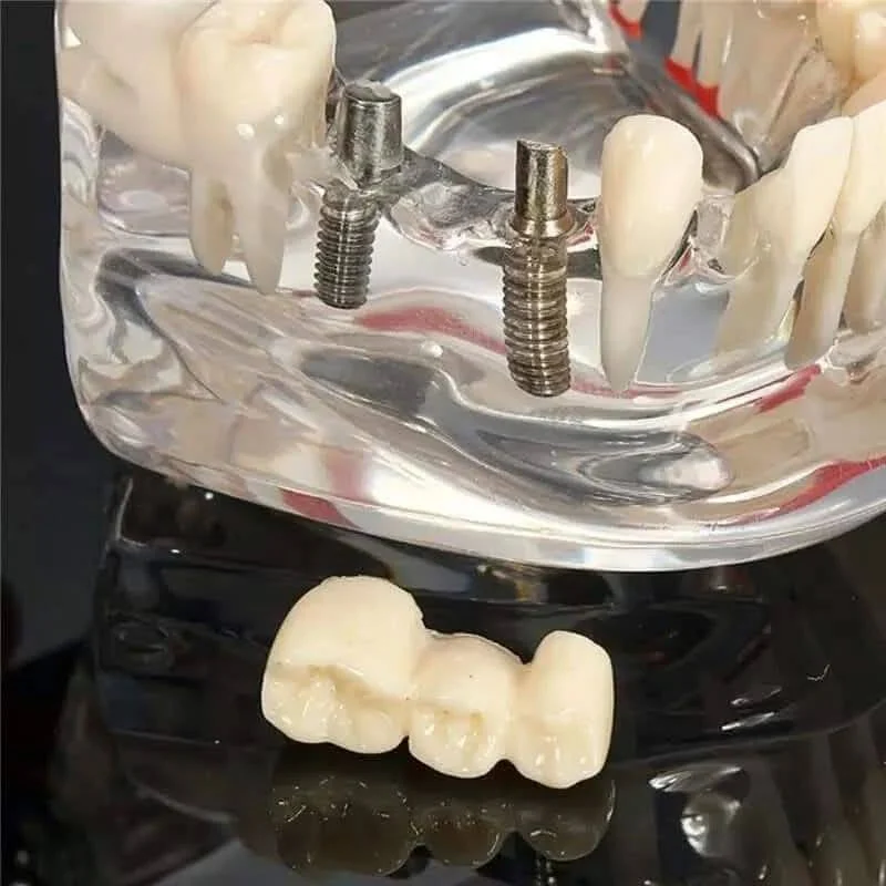 Dental Implant Model - Image 3
