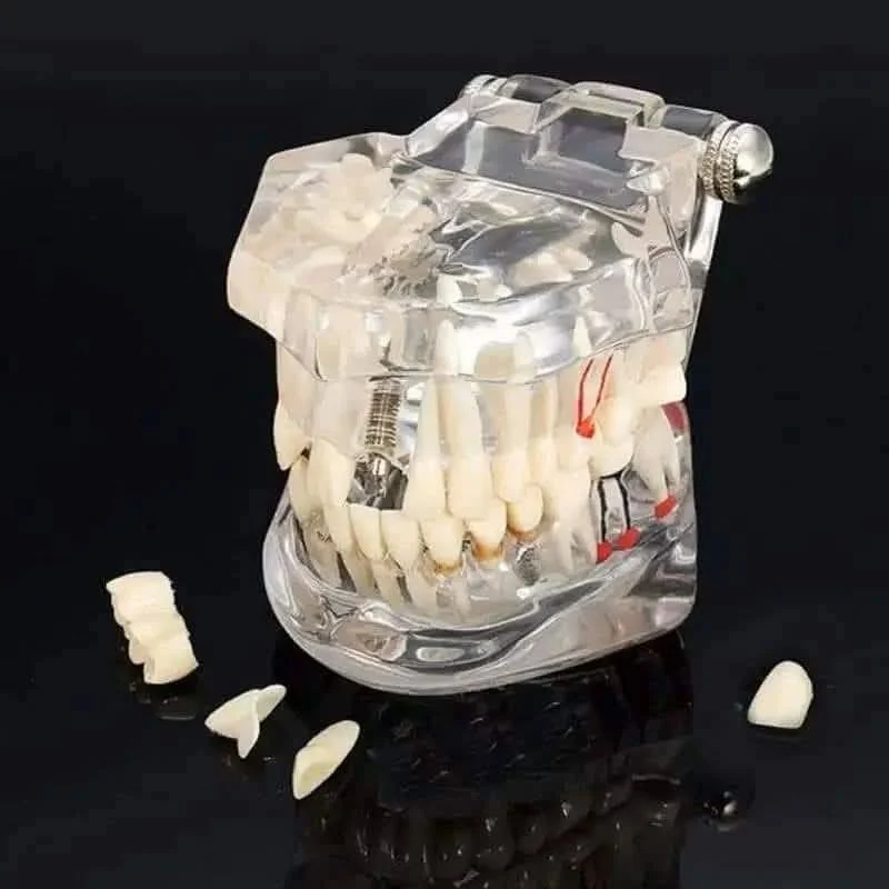 Dental Implant Model - Image 4