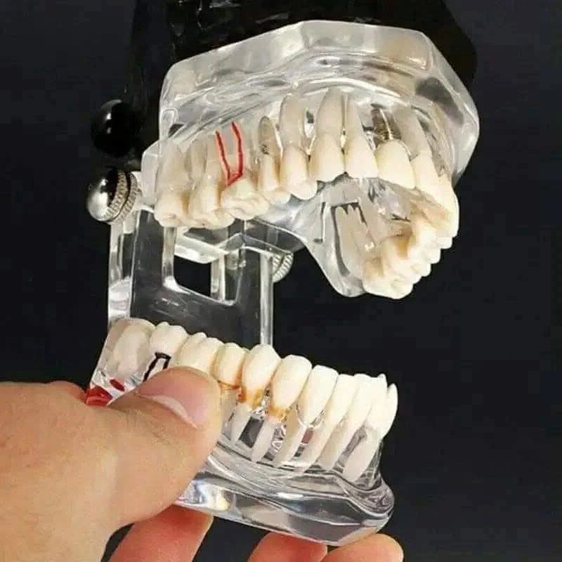 Dental Implant Model