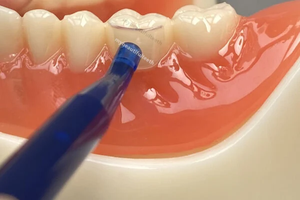 Transparent Cervical Martices – Class V Restorations - Image 4